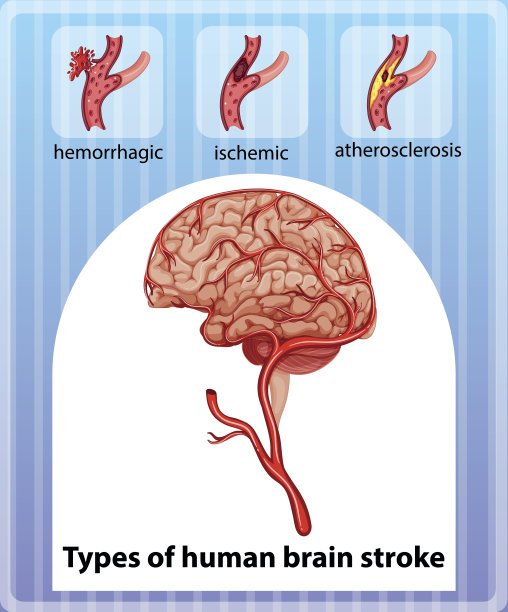 人类大脑中风的类型图片下载