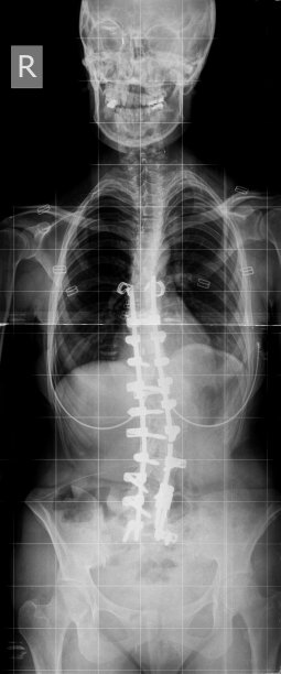 脊柱侧凸x线图像植入图片下载