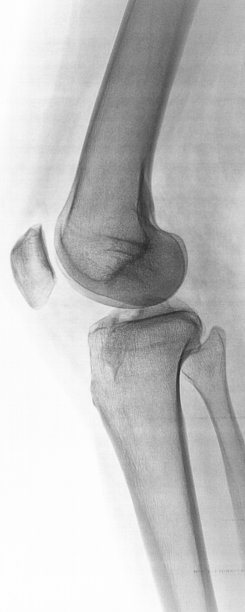 膝关节外侧x线倒置图片下载