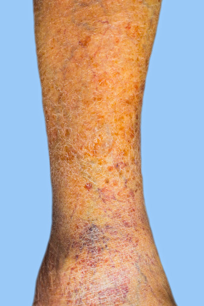 皮肤静脉曲张的特写素材图片