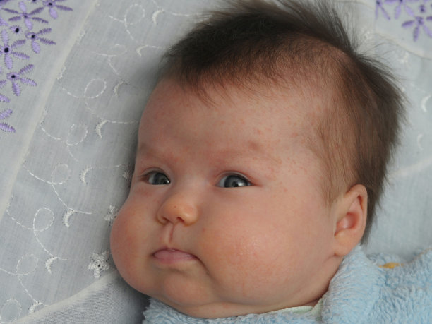 新生儿过敏素材图片