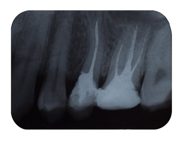 牙科x光片，白色背景图片下载