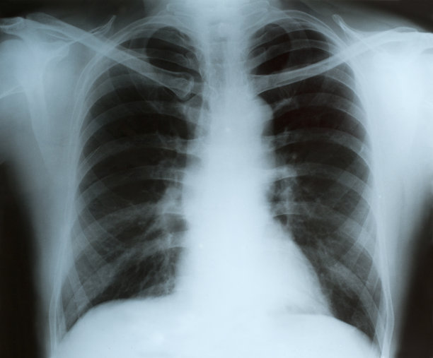 胸部x光片图片下载