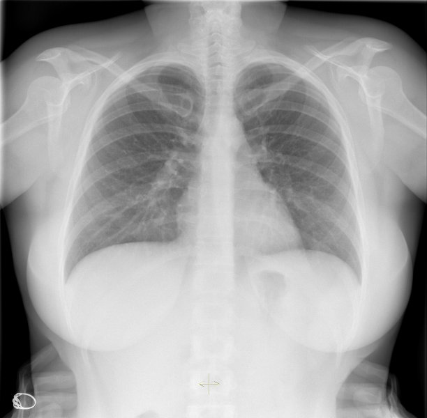 健康年轻女性的胸部X光片图片下载