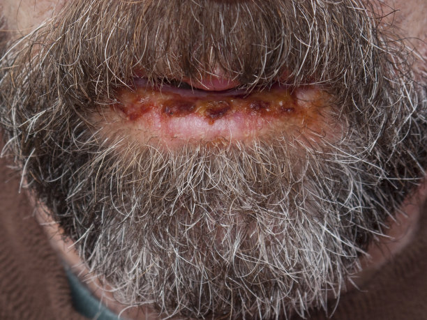 晒伤的嘴唇图片下载