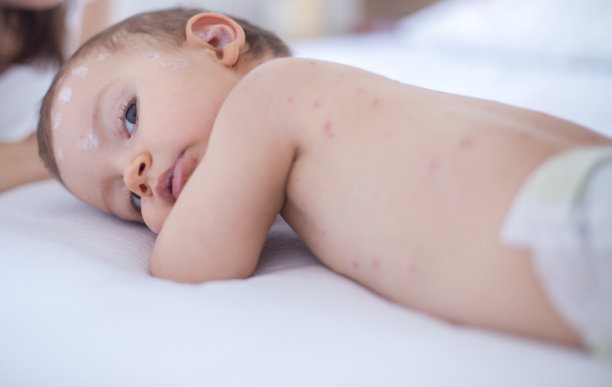 女婴得了水痘图片下载