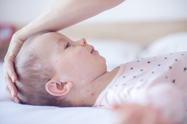 女婴得了水痘素材图片