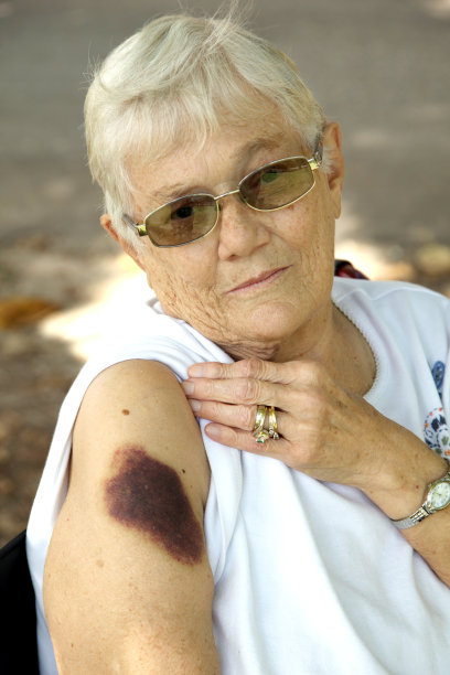 高级和瘀伤图片下载