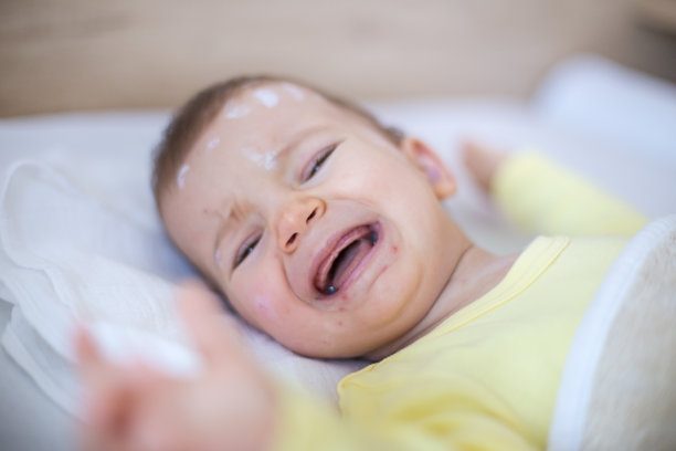 女婴得了水痘素材图片