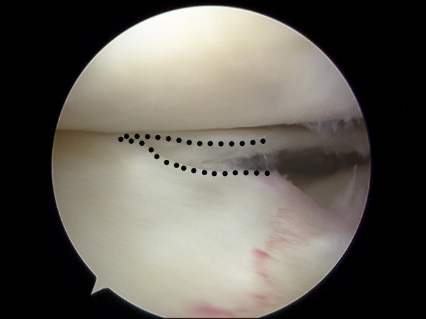外侧半月板桡骨撕裂的关节镜观察图片下载
