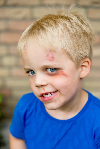 小男孩脸上有擦伤图片下载