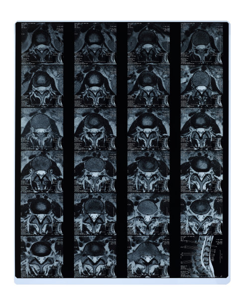 腰椎MRI横切面切片图片下载