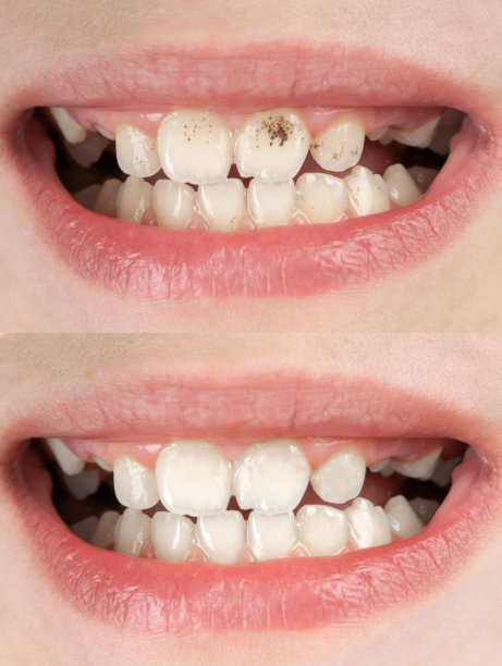 牙周炎(前/后)图片下载