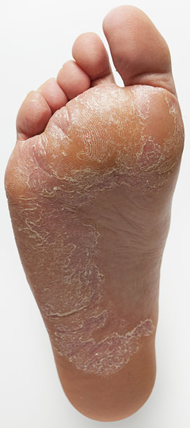 孤立的脚底与广泛的运动员脚问题图片下载