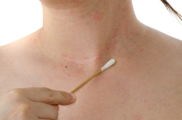 女人脖子上的湿疹皮肤图片下载