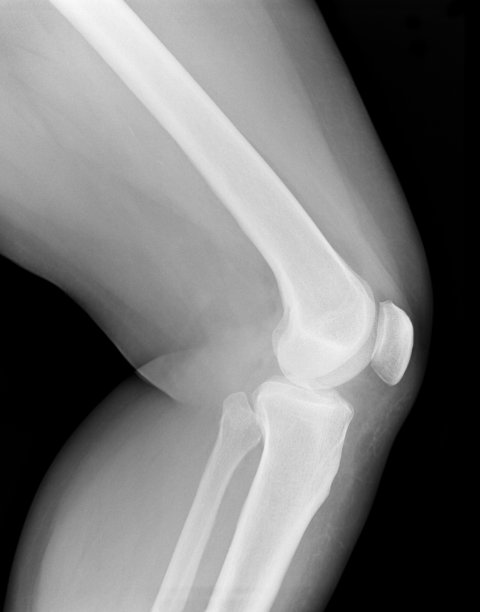 x光照片-膝盖图片下载