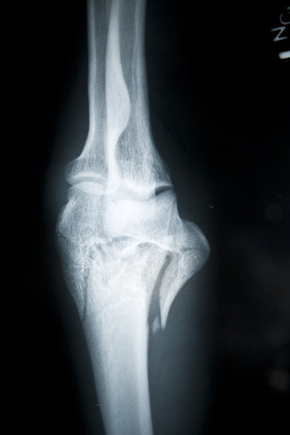 骨折的手肘X光照片图片下载