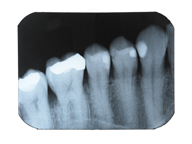 牙科x光图片下载