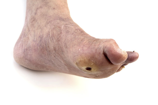 糖尿病足图片下载