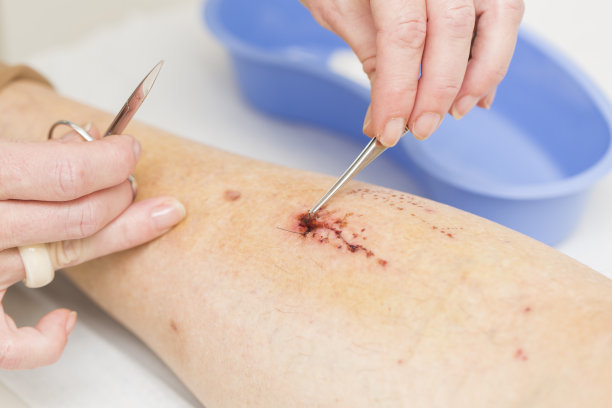 护士正在拆病人腿上伤口上的缝线图片下载