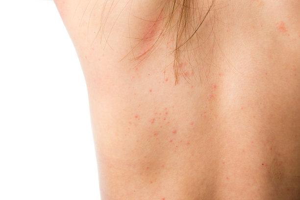 湿疹皮肤的人体背部细节纹理图片下载