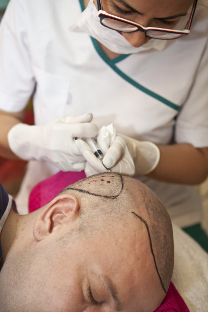 头发移植图片下载