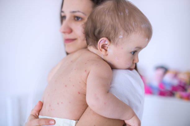 母亲在照顾患水痘的婴儿素材图片