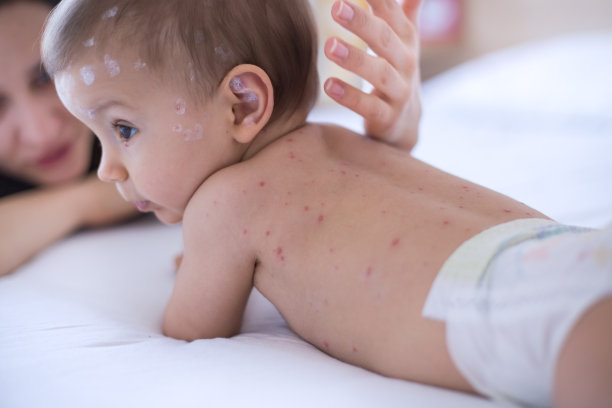 母亲在照顾患水痘的婴儿素材图片