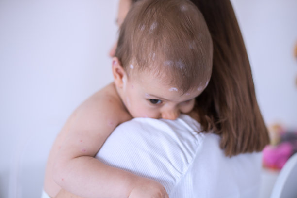 母亲在照顾患水痘的婴儿素材图片