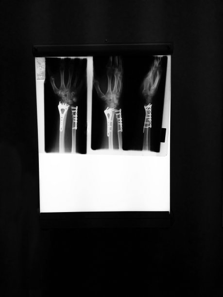 x光骨折手臂金属固定图片下载