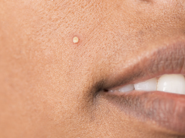 青春痘在脸上。图片下载