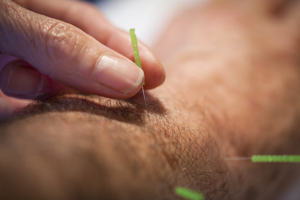 针灸。照明针图片下载