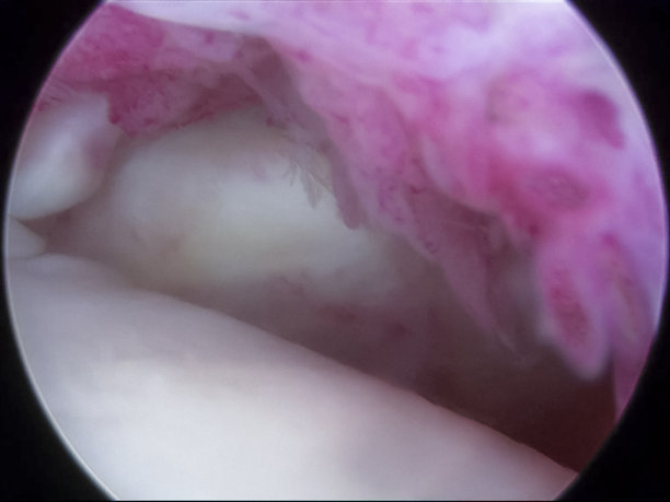 肩关节镜下粘连性囊炎(冻肩)的观察图片下载