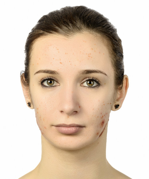 acnee问题图片下载