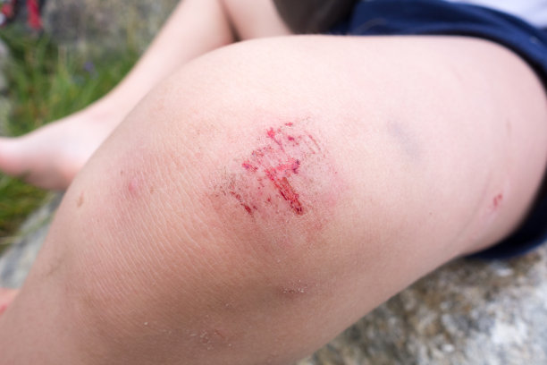 男孩腿上的淤青图片下载