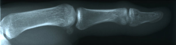 断了的手指图片下载