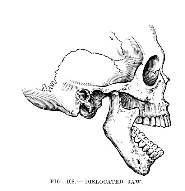 下巴脱臼图片下载