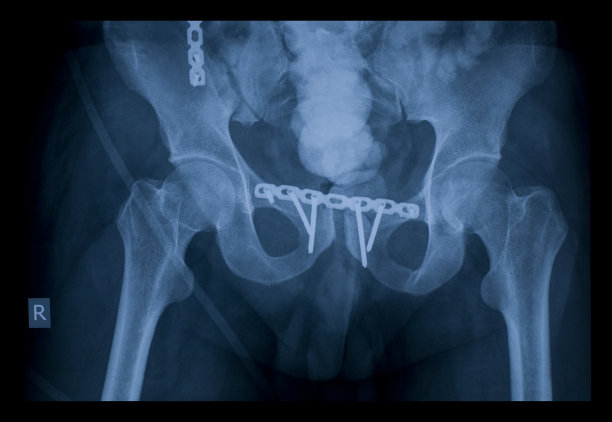 骨盆x线图像图片下载