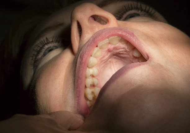 牙钻后的洞图片下载