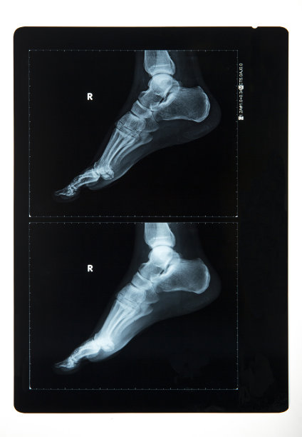一个男人的脚的x光图像图片下载