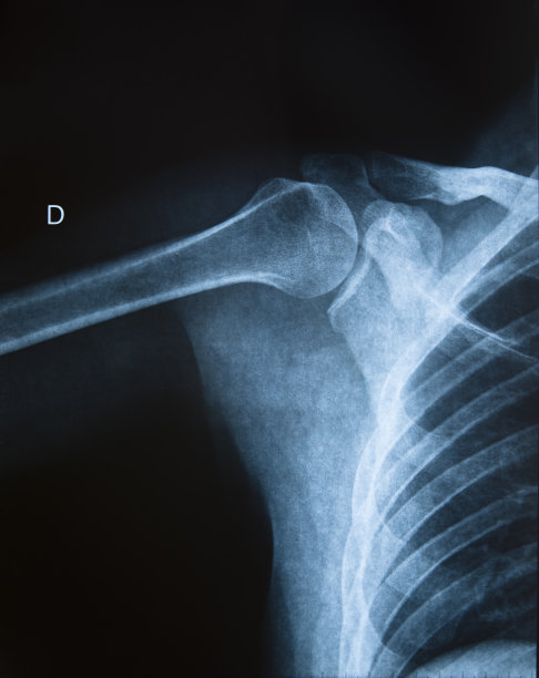 肩部x线图像图片下载