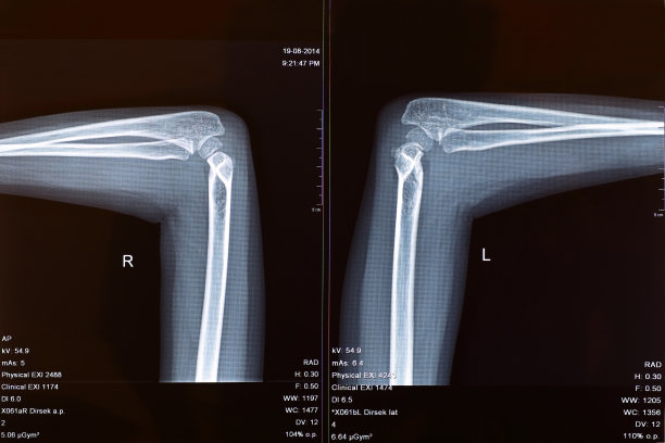 肘部X线影像图片下载