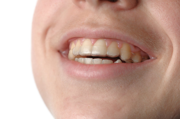 笑牙固位器在年轻人身上图片下载