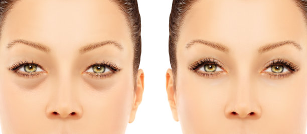 眼睑整容术。上眼睑整容术图片下载
