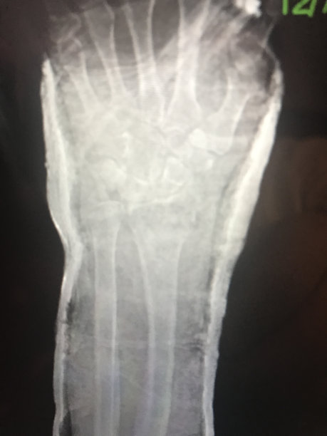 手部桡骨远端Colles骨折的腕部X光片图片下载