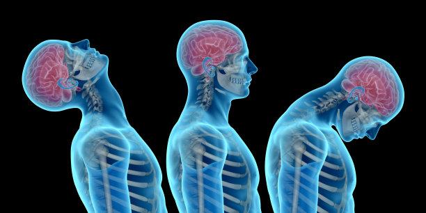 人体解剖，显示颈部损伤，如颈部鞭伤图片下载