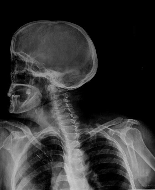人的头部和胸部x光图像图片下载