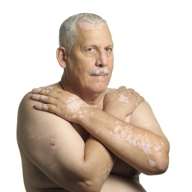 患有白癜风的成熟男子图片下载