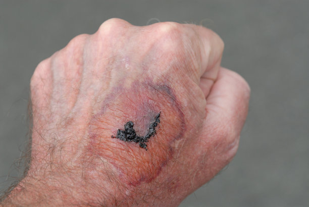 受伤的手图片下载