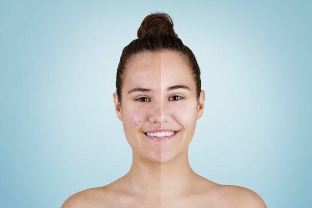 痘痘前后素材图片